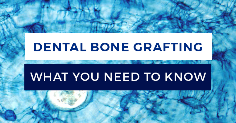 dental bone grafting what you need to know 