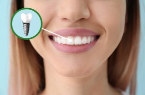 Woman smiling showing her perfect dental implant